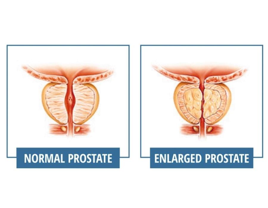 prostatitis vagy varicoceliers